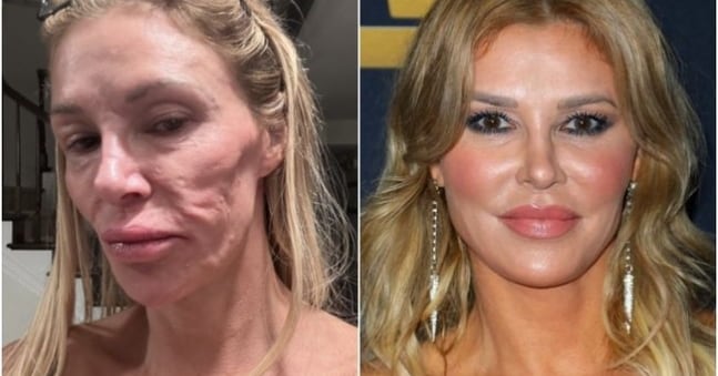 Brandi Glanville's Facial Deformity Linked to Ruptured Implant - 조선일보