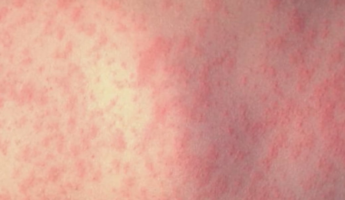 Mo. & Ill. health officials warn of possible measles exposures in St. Louis area