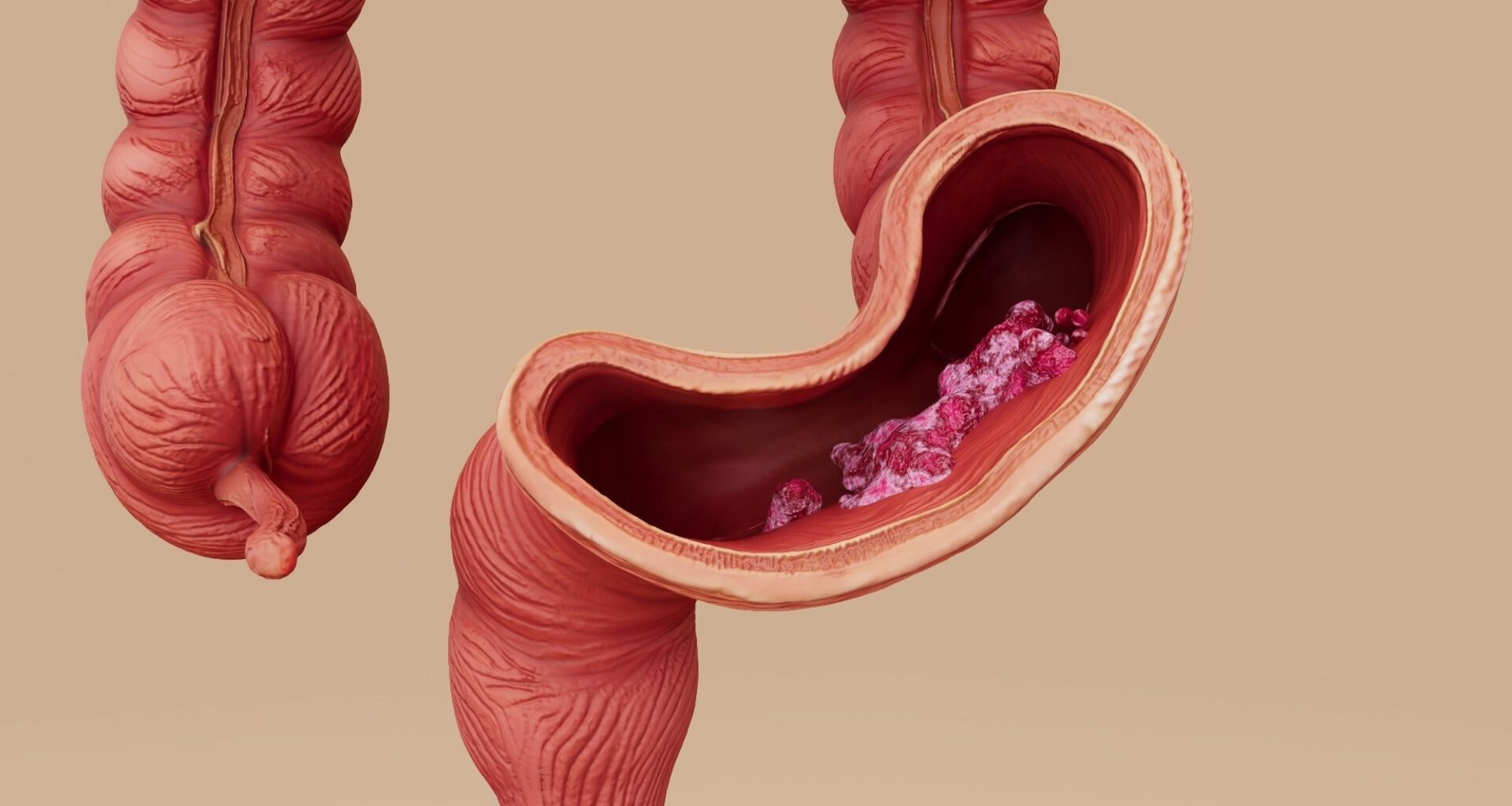 The Role of the Gut Microbiome in Gastrointestinal Cancer Development