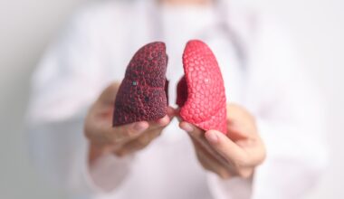 Opinion: Lung cancer in never smokers: from early detection to prevention. Image Credit: Jo Panuwat D / Shutterstock