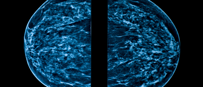 Stage IV Breast Cancer Survival Increased By Screening