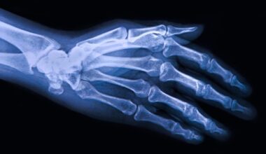 Therapeutic potential of engineered extracellular vesicles in osteoarthritis