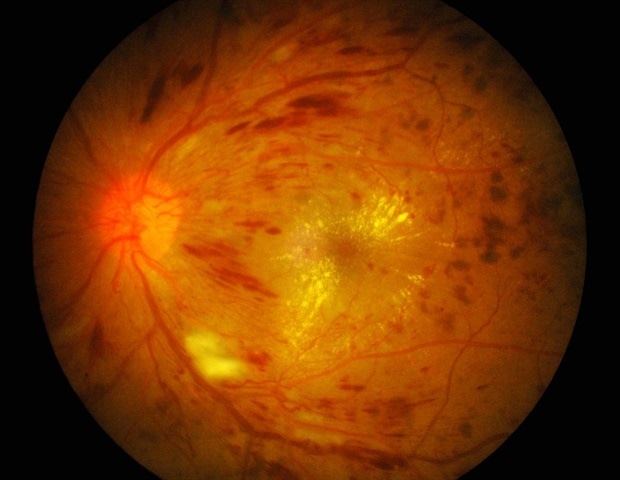 Posture-induced retinal vascular response predicts diabetic retinopathy progression