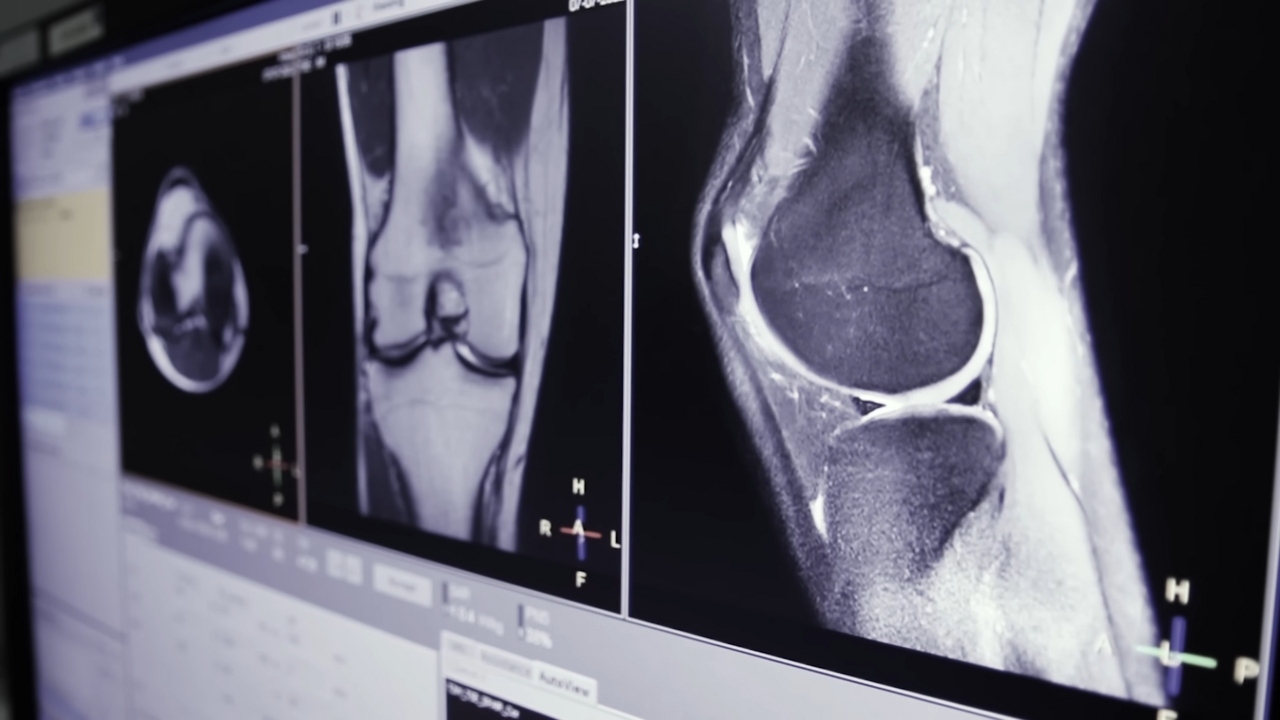 Scientists Just Found a Way to Regrow Cartilage Without Stem Cells, And It Could Change Arthritis Treatment Forever