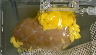 Scientists Created a 'Universal' Kidney To Match Any Blood Type : ScienceAlert