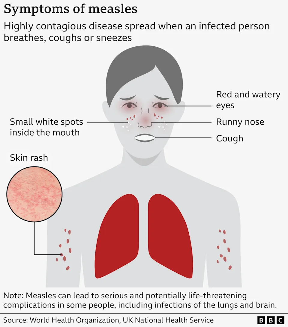Graphic showing how measles symptoms present on a body, including red and watery eyes, runny nose, a cough, a skin rash and small white spots inside the mouth. The lungs are also highlighted, reflecting the risk of possible chest infection. 