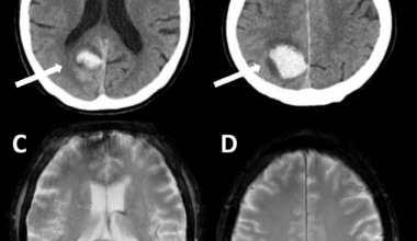 Resolution of Visual Hallucinations in Parkinson’s Disease After Right Occipitoparietal Subcortical Hemorrhage: A Case Report
