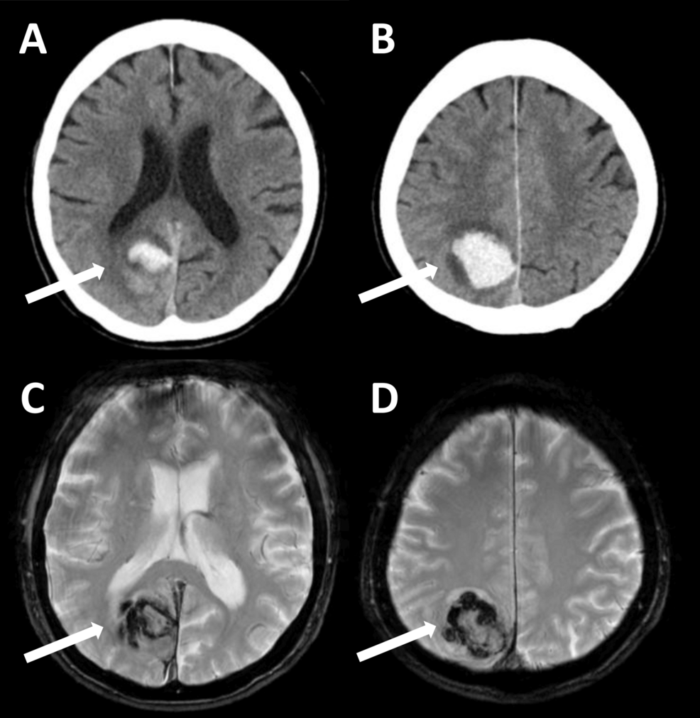 Resolution of Visual Hallucinations in Parkinson’s Disease After Right Occipitoparietal Subcortical Hemorrhage: A Case Report