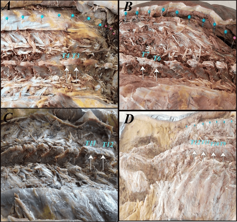 Prevalence of Fusion Between Adjacent Thoracic Spinous Processes in Adult Cadavers