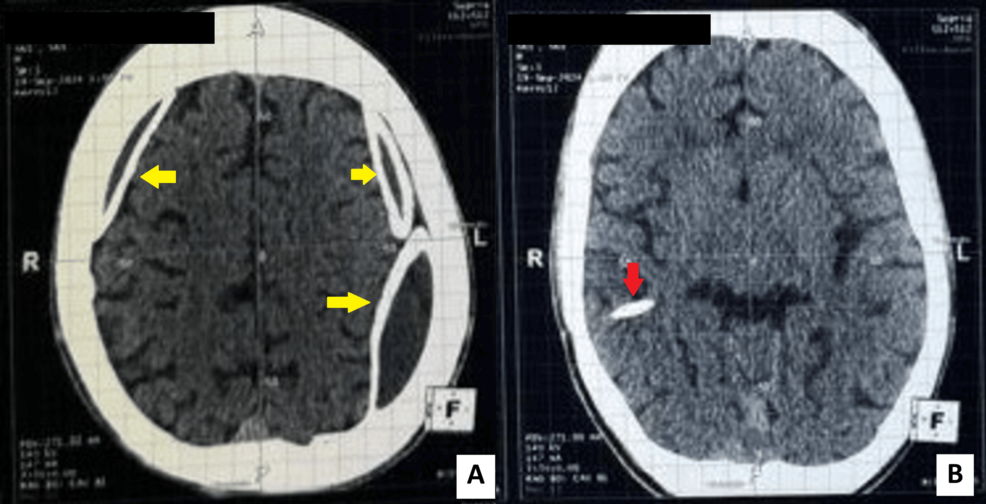 Ventriculoperitoneal (VP) Shunt-Associated Calcified Chronic Subdural Hematoma: Armored Brain Management With Shunt Revision