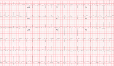 Stress-Induced Takotsubo Cardiomyopathy Identified by Unique Nuclear Perfusion Pattern