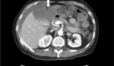 Ruptured Superior Mesenteric Artery Pseudoaneurysm With Hemorrhagic Shock Secondary to Infectious Colitis: A Case Report