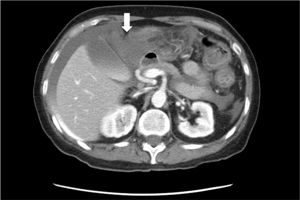 Ruptured Superior Mesenteric Artery Pseudoaneurysm With Hemorrhagic Shock Secondary to Infectious Colitis: A Case Report