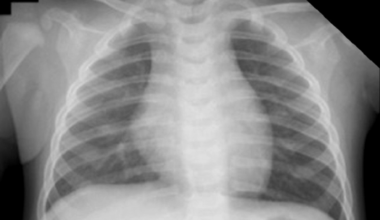 Unexpected Subglottic Stenosis Detected During Difficult Intubation for the Induction of General Anesthesia: A Case Report