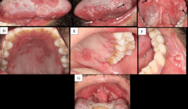 Oral Manifestations of Secondary Syphilis
