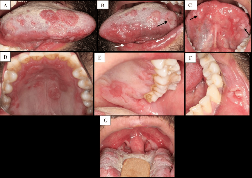 Oral Manifestations of Secondary Syphilis
