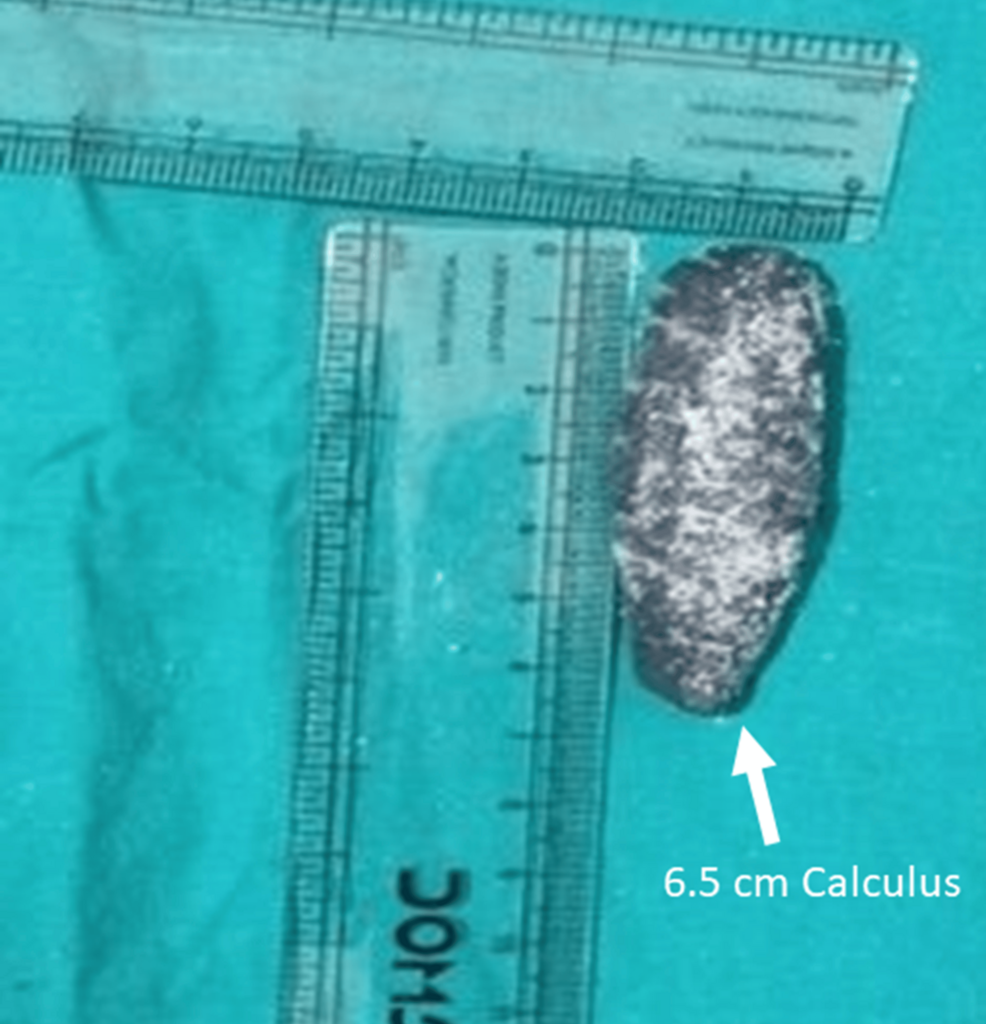 Giant Distal Ureteric Calculus in a Tertiary Care Center: Our Experience