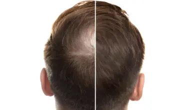 Ancient Chinese medicine may hold the key to hair regrowth