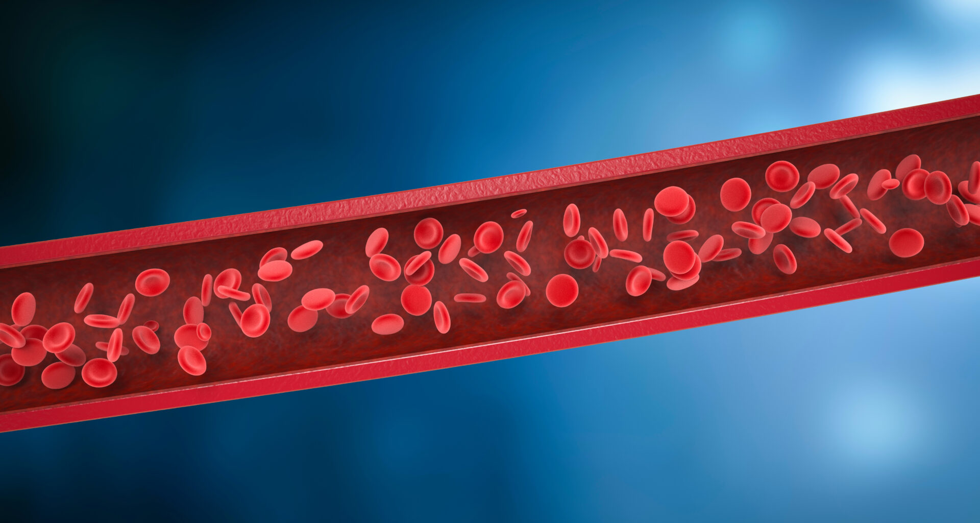 High Response Rates With Front-Line Pivekimab Sunirine in BPDCN
