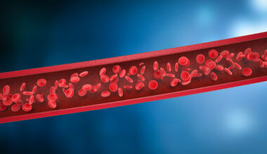 High Response Rates With Front-Line Pivekimab Sunirine in BPDCN