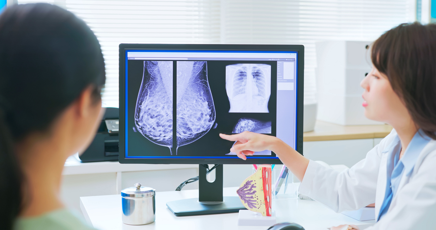 Randomized Trial Shows AI-Supported Mammography Improves Sensitivity and Lowers Interval Cancer Rate