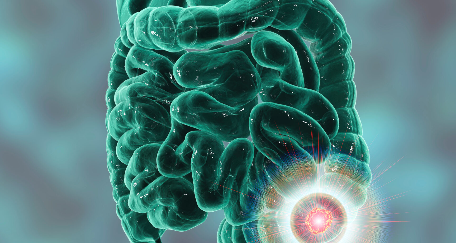 Tissue-Free ctDNA and Outcomes in Patients With Colorectal Cancer Receiving FOLFOX-Based Adjuvant Therapy