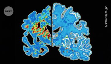 Blood test holds promise for predicting when Alzheimer’s symptoms will start