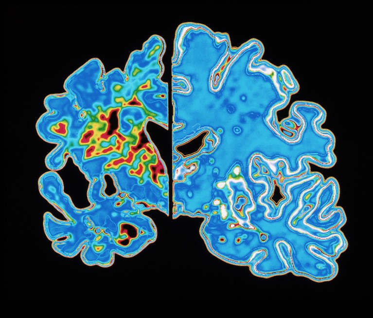 Computer graphic of a blue vertical slice through the brain of an Alzheimer's patient on the left and a normal brain on the right on a black background