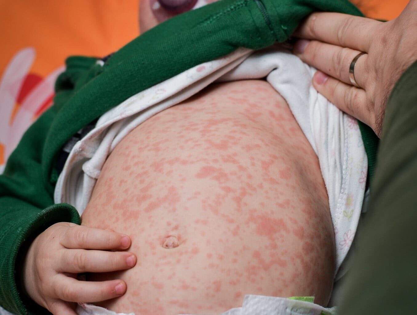 Year-old child dies of measles in Jerusalem, in 14th fatality of outbreak