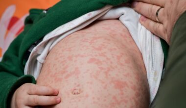 Year-old child dies of measles in Jerusalem, in 14th fatality of outbreak