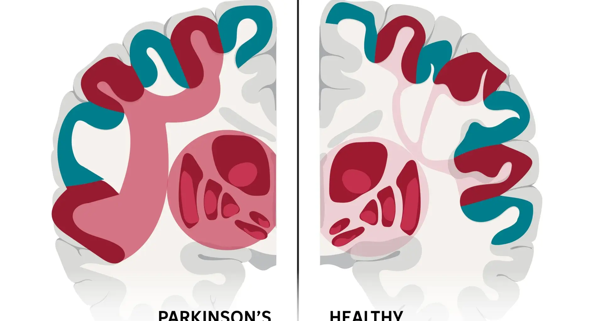 Scientists may have found the brain network behind Parkinson’s