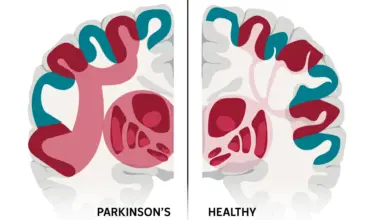 Scientists may have found the brain network behind Parkinson’s