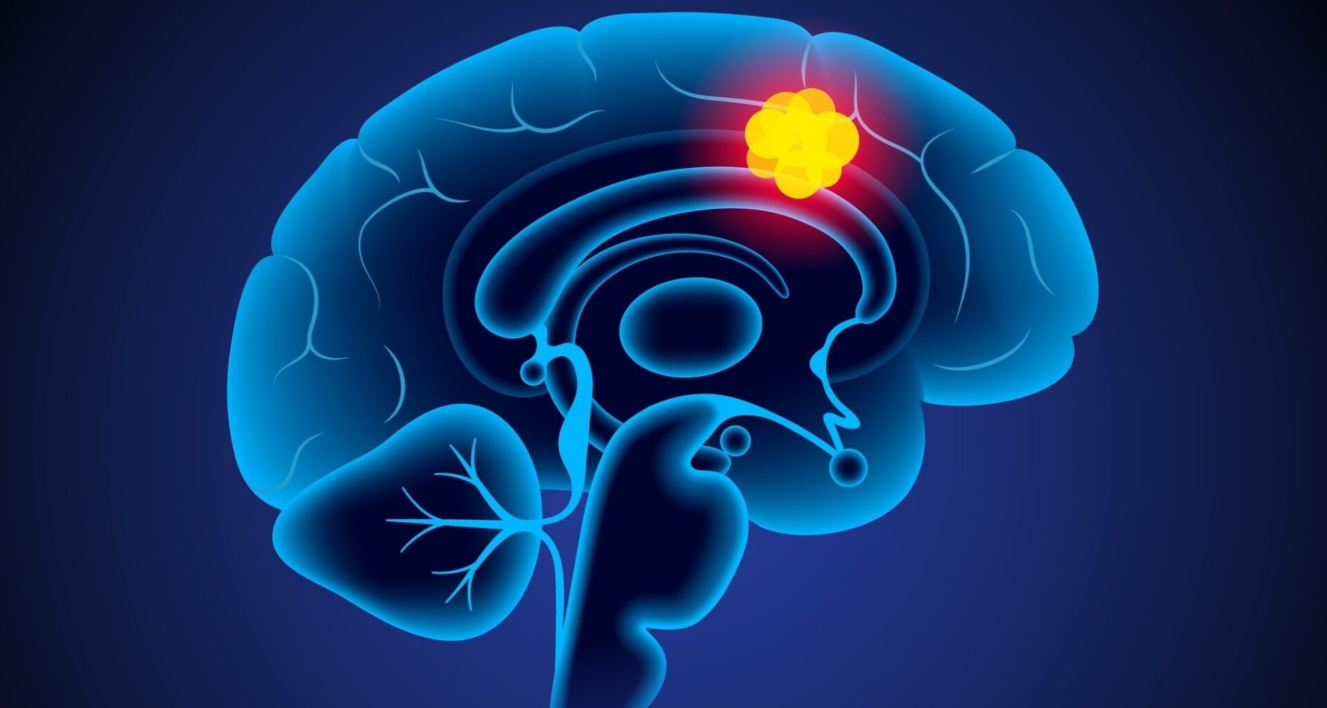 Organ-on-a-chip tests immune wafer for glioblastoma