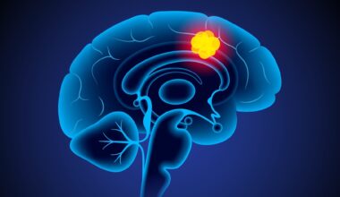 Organ-on-a-chip tests immune wafer for glioblastoma