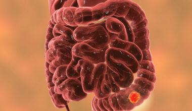 Adding Encorafenib and Cetuximab to FOLFIRI Shows Benefit in BRAF-Mutant Colorectal Cancer