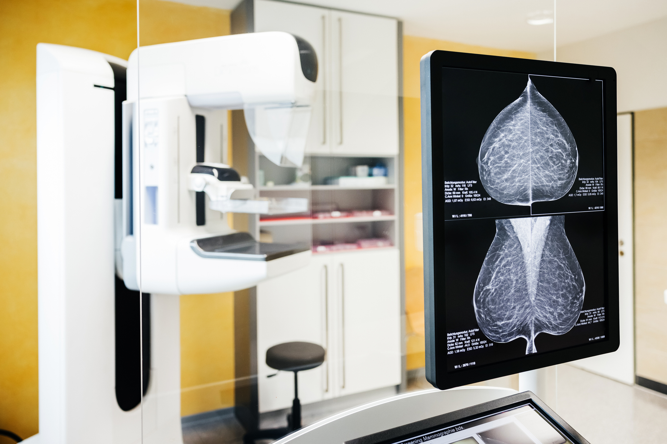 Mammogram images displayed on a screen next to a mammography scanner.