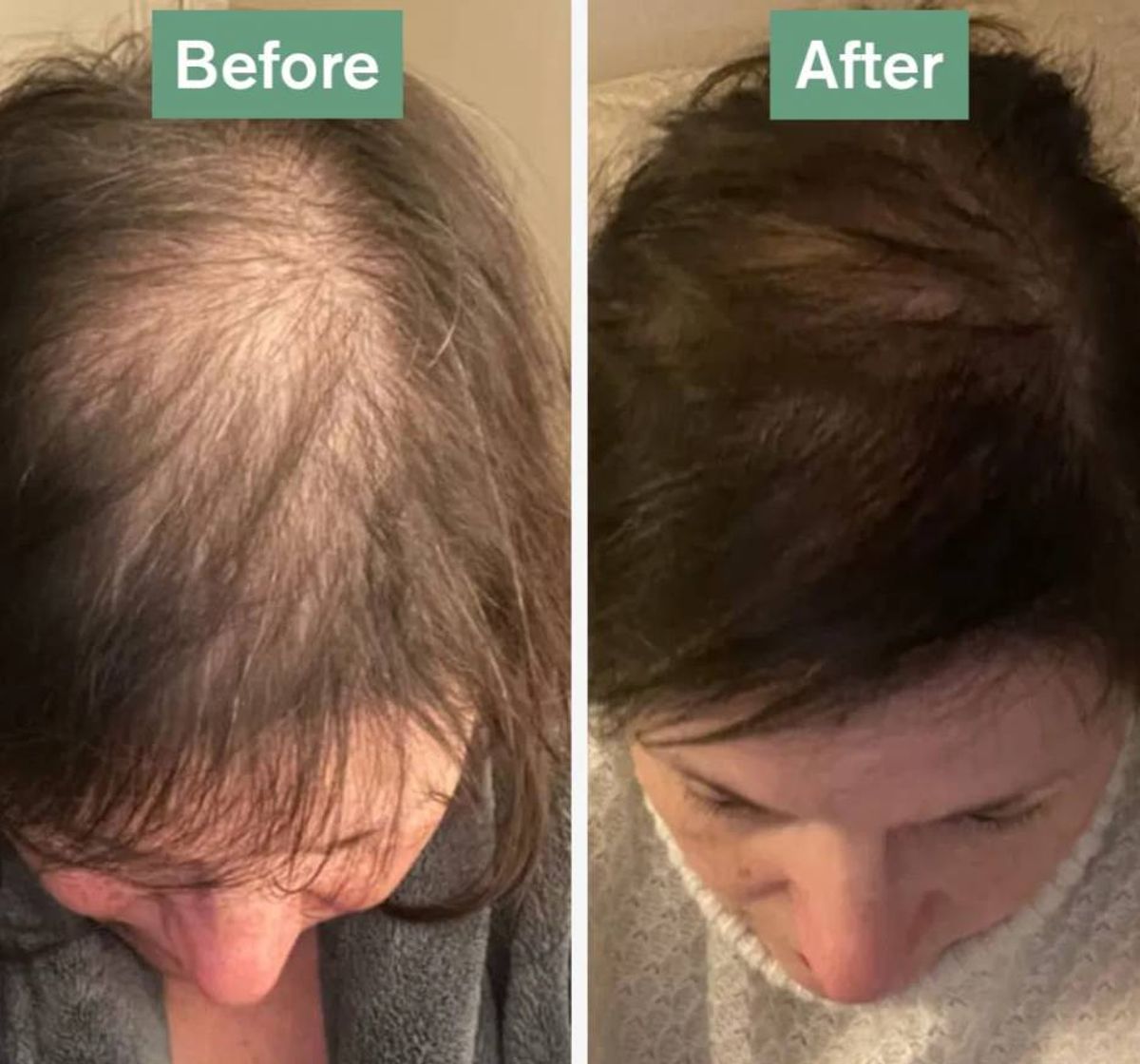 A comparative image displaying the progression of hair condition before and after a treatment. The left side shows a head with significant hair thinning, while the right side shows a head with visibly fuller and healthier hair.