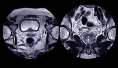 AI Improves Prostate Cancer Biopsy Selection