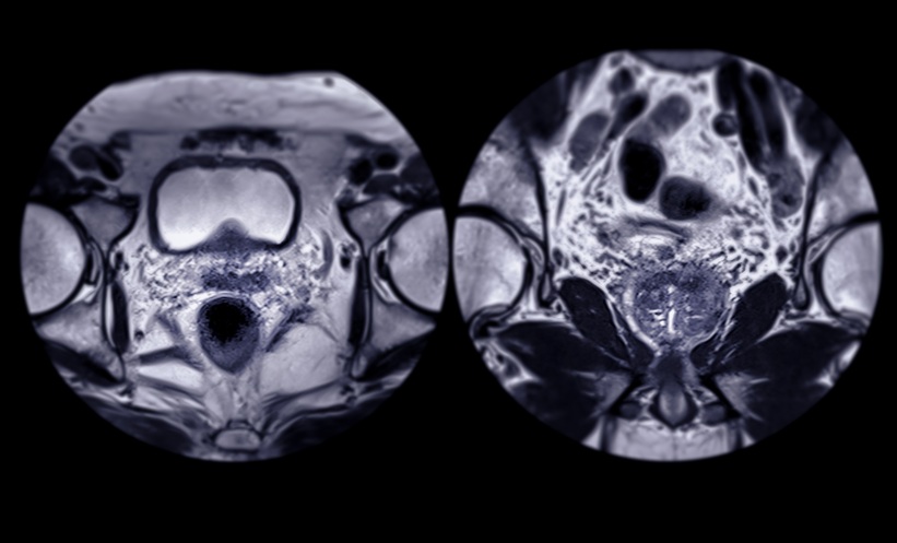 AI Improves Prostate Cancer Biopsy Selection