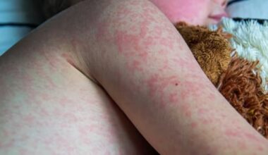 Babies exposed to measles getting preventive treatment every week in Manitoba