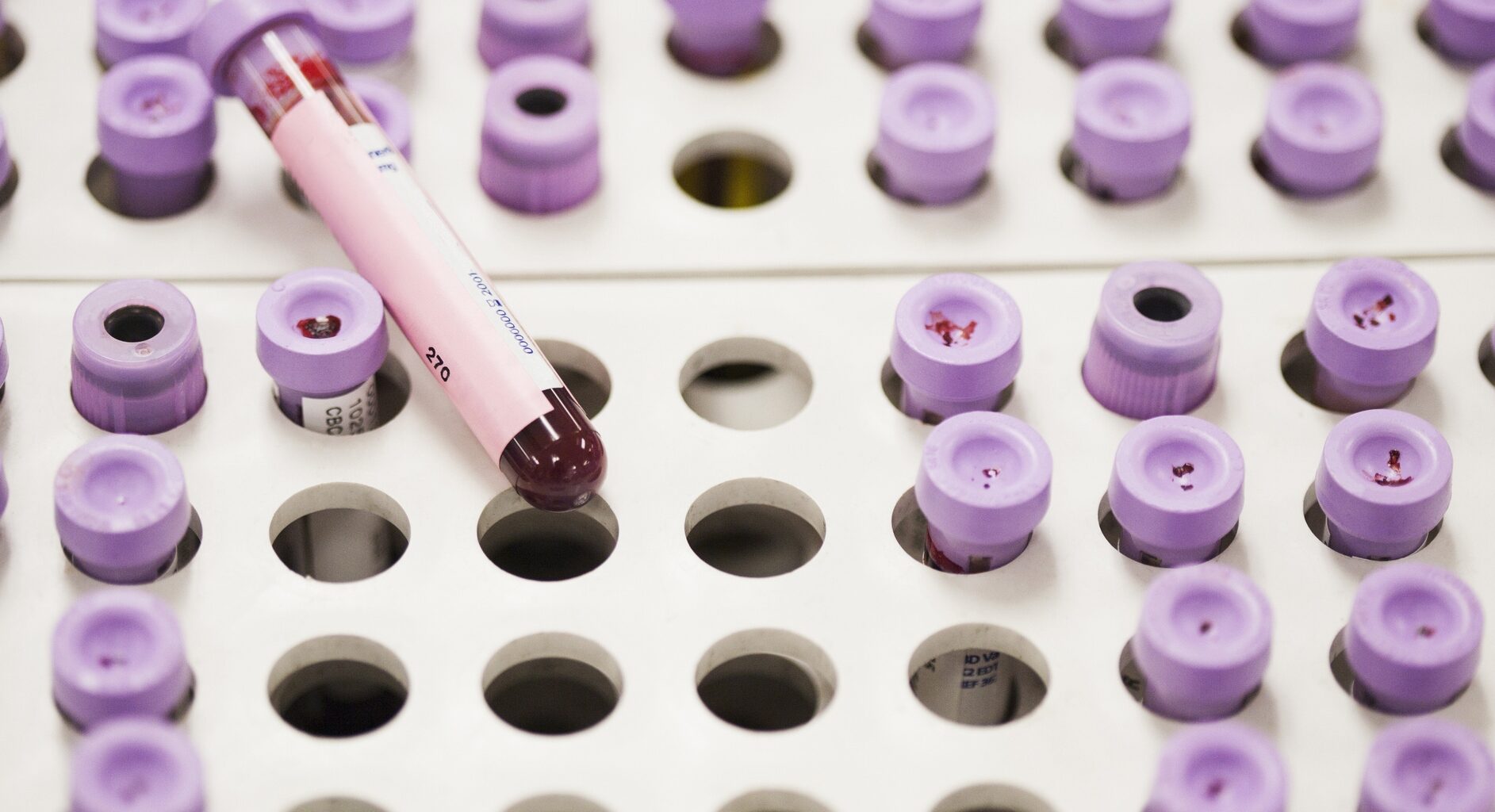 A cholesterol test you've never heard of is now recommended to prevent heart disease