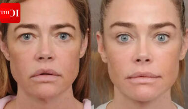 Denise Richards opens up about facelift; surgeon hails actress for bravely sharing 'before and after' pics of work done on forehead, eyes, mouth, neck |