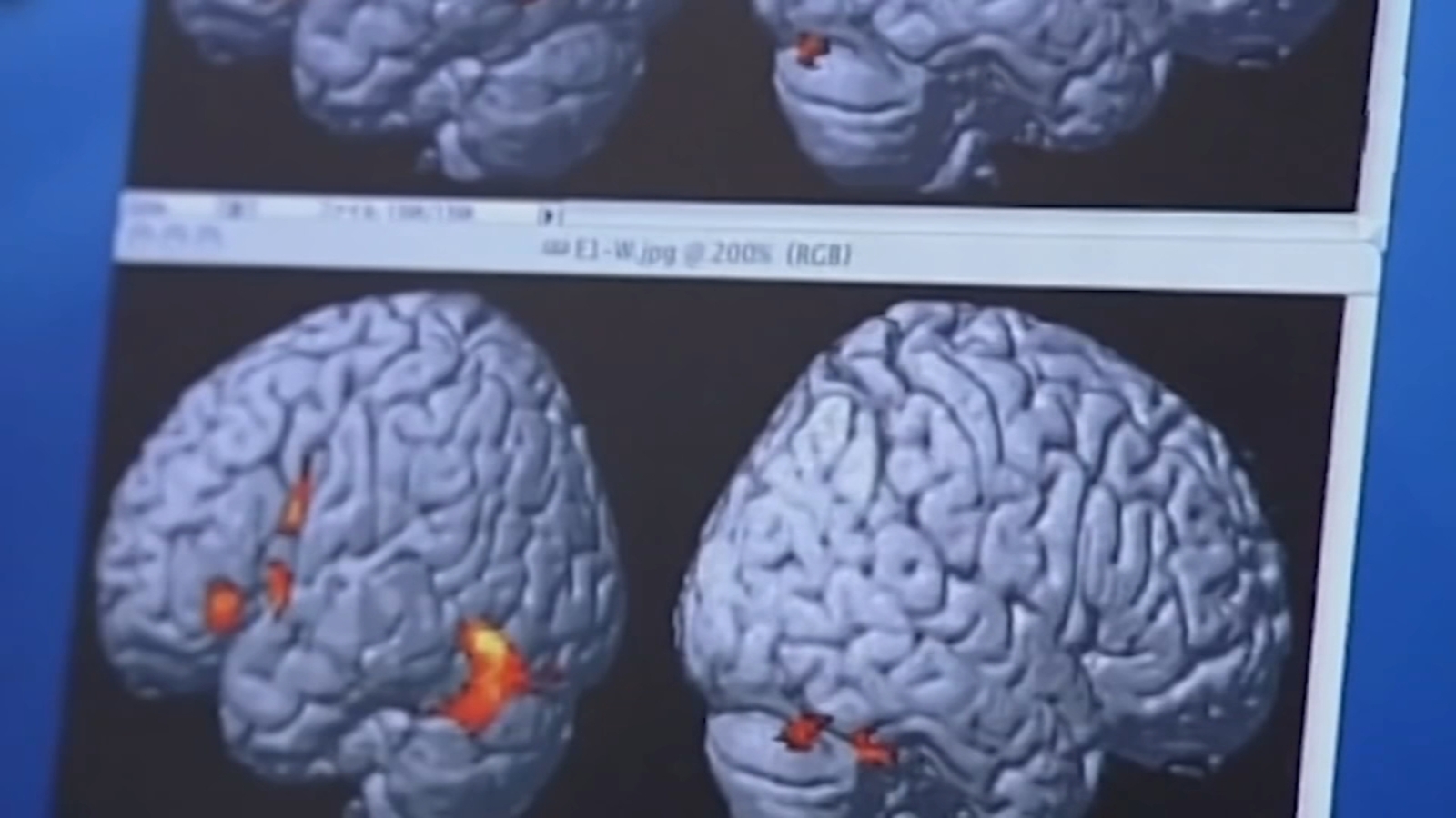 Duke nursing student joins national push to improve early Alzheimer's detection