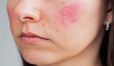 Rosacea and Depression Risk: New Cohort Evidence - EMJ