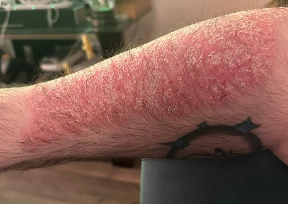 Maddox Patt's plaque psoriasis.Credit: Courtesy of Maddox Patt