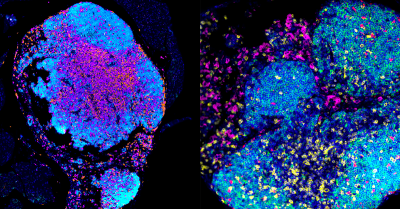 Rewiring Immune System Offers New Path to Better Ovarian Cancer Treatment