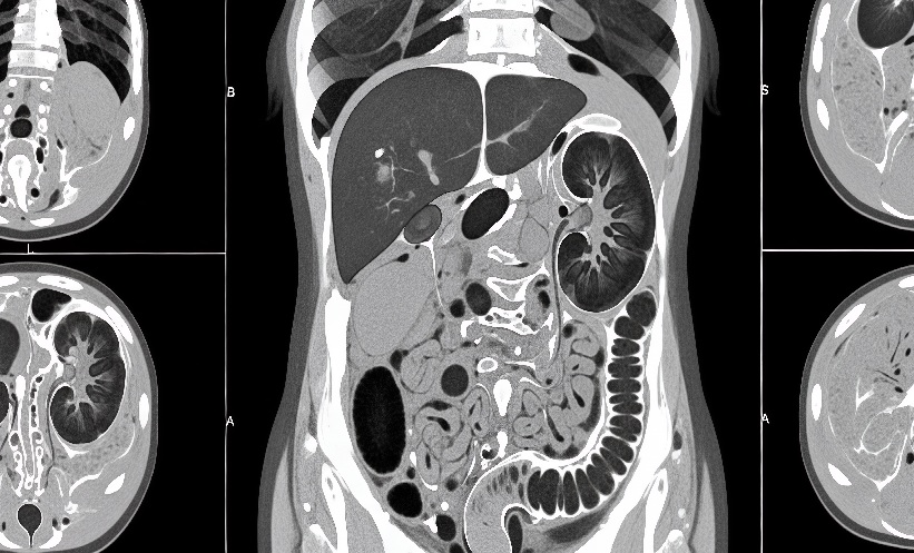 Rising CT Scans in Elderly Raise Radiation Questions – EMJ