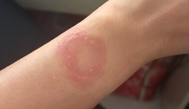 Apple Watch owner says the wearable caused a wrist burn