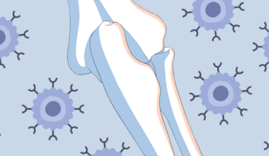 OSM CAR-T: Hope for Common Type of Bone Cancer