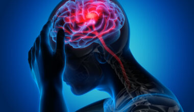 AI Support Tool Reduces Vascular Events After Stroke by 27% 